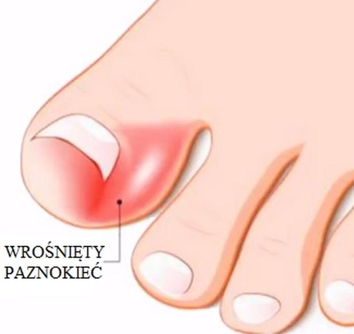 Przyczyny i objawy wrastających paznokci