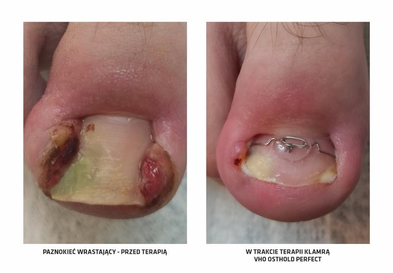 Wrastający paznokieć