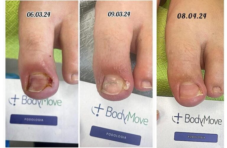 Wrastający paznokieć: co warto wiedzieć o zabiegu i jego odczuciach bólowych