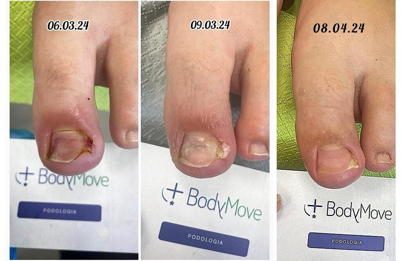 Wrastający paznokieć: co warto wiedzieć o zabiegu i jego odczuciach bólowych