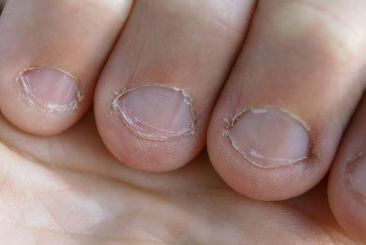 Psychologiczne przyczyny obgryzania paznokci