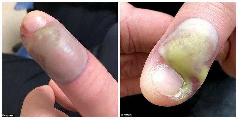 Techniki walki z obgryzaniem paznokci