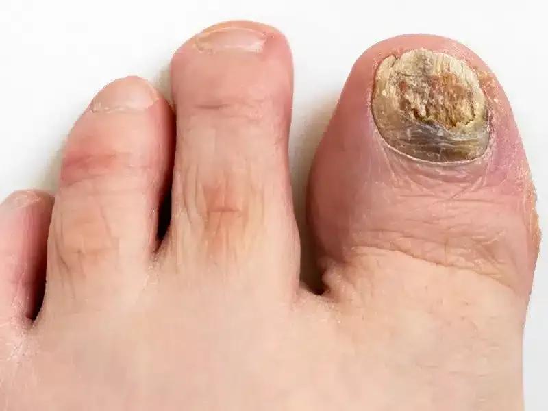 Grzybica paznokci a zakażenia – co warto wiedzieć?